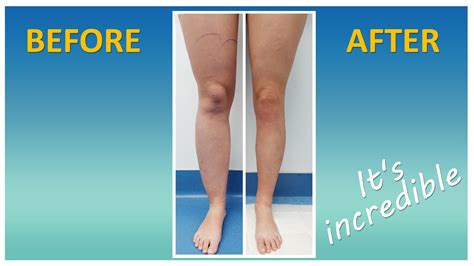 Lipedema Leg Liposuction Surgery Results Lipo Legs Cankles Knees Expert Dr