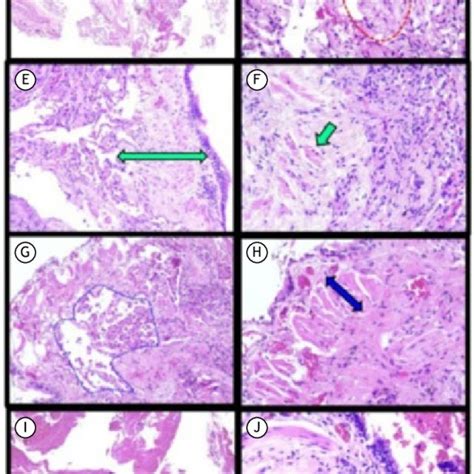 Histopathological Panel Of Transbronchial Biopsy Samples Collected From