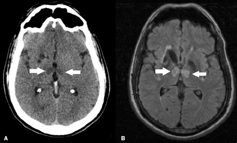 Bilateral Thalamic Infarcts In A Patient With A Sudden Decrease In The Download Scientific