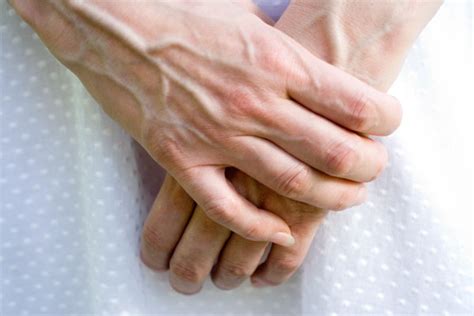Hand Arm And Foot Veins British Varicose Vein Centre