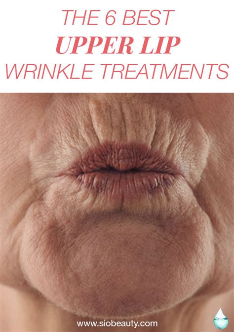 The 6 Best Upper Lip Wrinkle Treatments