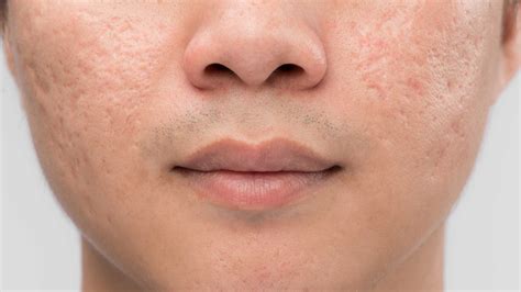 What Causes Acne Scarring And What Treatments Are There