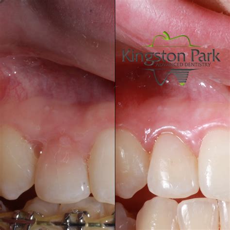 Tooth Resorption A Complication Of Orthodontic Treatment