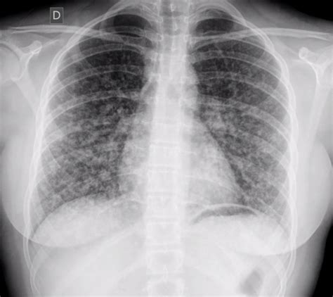 Papillary Thyroid Cancer Chest X Ray Wikidoc