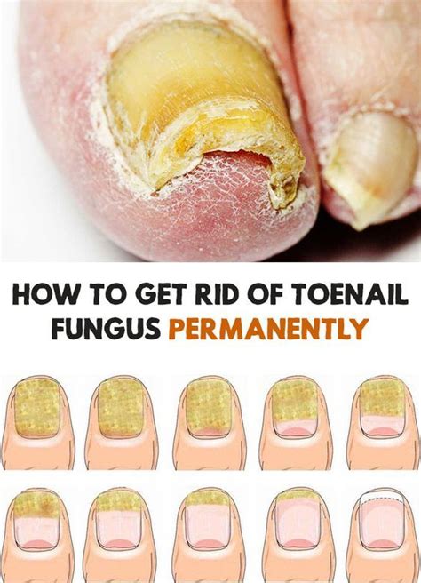 The Toenail Fungus Is Unfortunately Very Common Read About How To