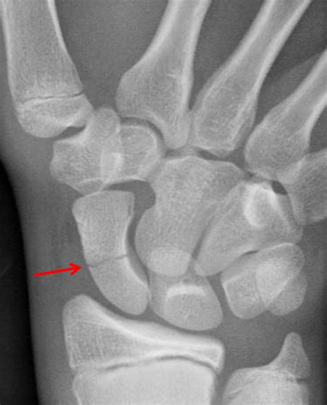 Scaphoid Fracture Types