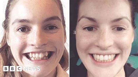 Adult Braces Why Are More Grown Ups Getting Their Teeth Straightened