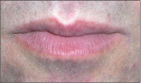Skin Discoloration Around Mouth