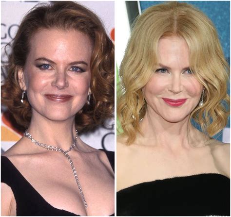 Nicole Kidman Et La Chirurgie Esthétique - Nicole Kidman’s Before and After Photos Look Different, but She Denied
