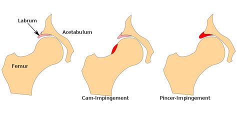 First Best Practices Guide For Femoroacetabular Impingement