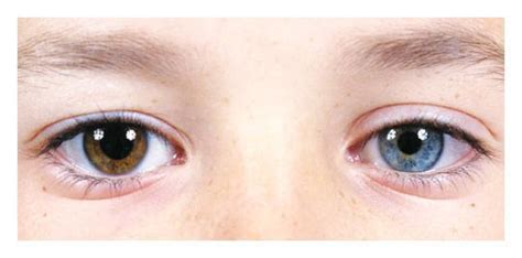 Medical Mystery — One Brown Eye And One Blue Eye — Nejm