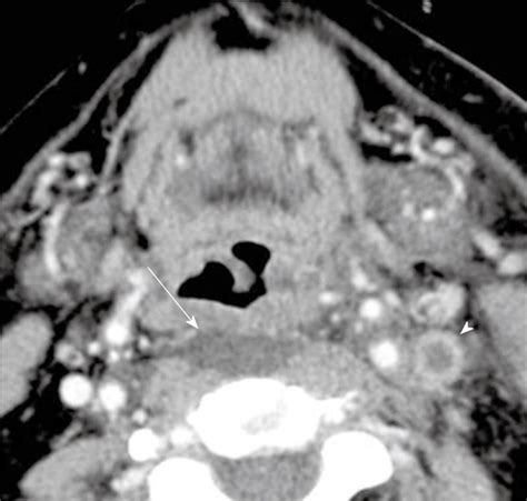 Computed Tomography Imaging Of Acute Neck Inflammatory Processes