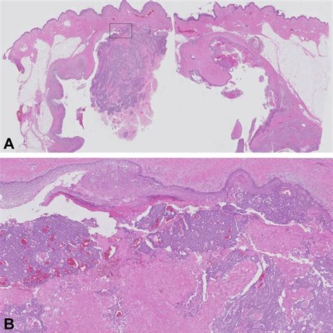 The Metastatic Dissemination Of A Squamous Cell Carcinoma Arising From