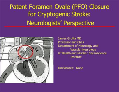 Patent Foramen Ovale Pfo Closure For Cryptogenic Stroke Neurologists