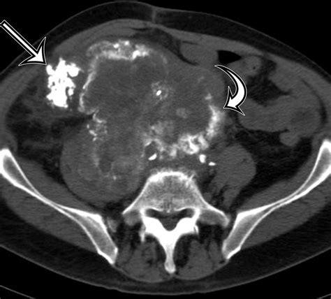 Soft Tissue Sarcomas Of The Abdomen And Pelvis Radiologic Pathologic