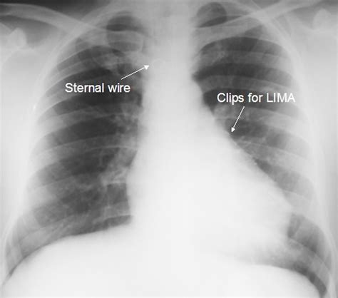 Post Cabg X Ray Chest Pa View All About Cardiovascular System And