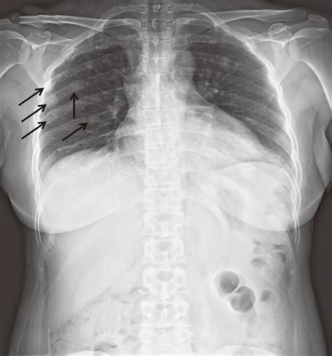 Chest X Ray Showed Multiple Sclerotic Lesions Of Right Open I