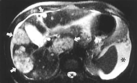 Hepatic Hemangioma Atypical Appearances On Ct Mr Imaging And