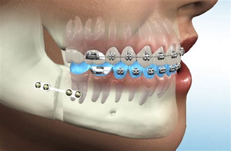 Oral And Maxillofacial Surgery Java Dent