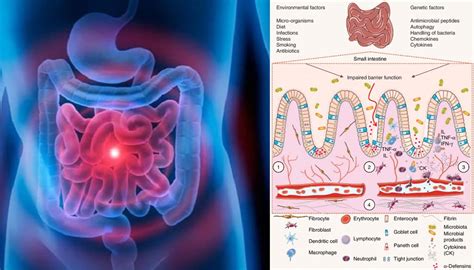 Diagnosis Of Inflammatory Bowel Diseases Has Been Linked