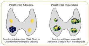 Parathyroid Adenoma And Hyperplasia Graphic Hyperparathyroidism