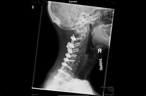 Posterior Cervical Fusions Dr Wayne Kelley Jr Md