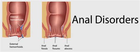 Anal Fissures Causes Symptoms And Treatment