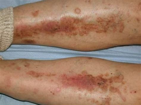 Diabetic Dry Skin On Legs Pictures Symptoms And Pictures Hot Sex Picture