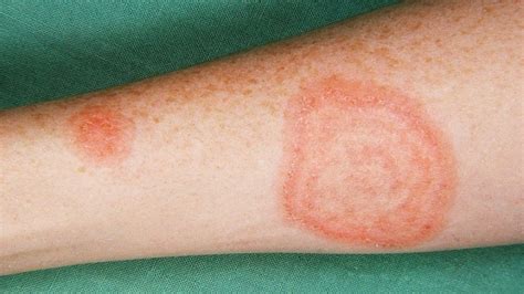 Common Skin Rashes What To Look Out For And How To Treat Them Trends