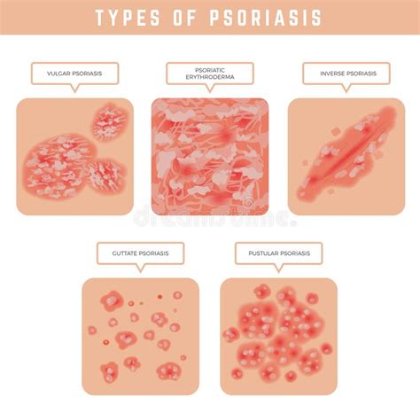 Types Of Psoriasis Pustular And Not Pustular Vulgar Erythroderma