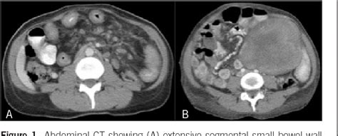 Pdf Mesenteric Fibromatosis In Crohns Disease As A Potential Effect