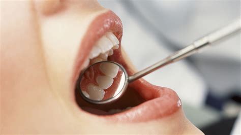 Muelas Del Juicio ¿cuándo Es Necesario Extraerlas Clínica Dental En