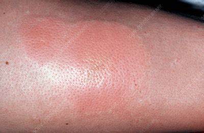 Rash On Arm Following Insect Bite Stock Image M Science Photo Library