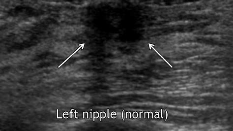 an analysis of nipple enhancement at breast mri with radiologic pathologic correlation
