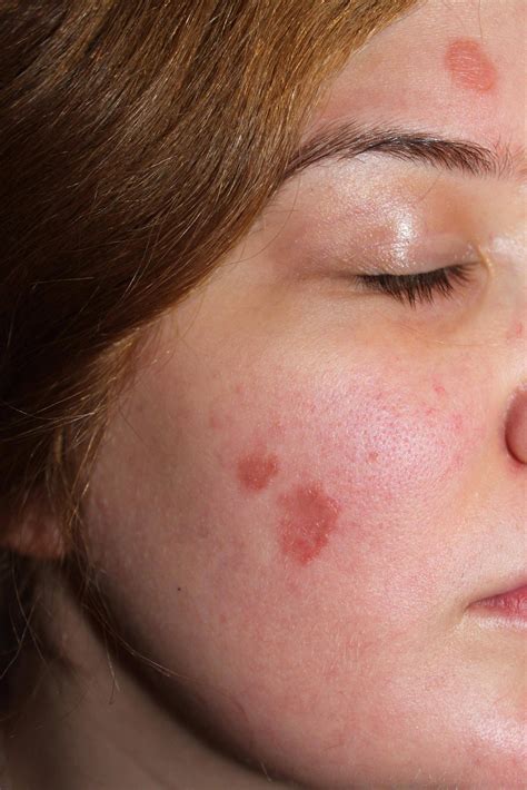 Red Dry Skin Patches On Face Atopic Dermatitis Symptoms