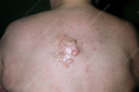 Dermatofibrosarcoma Protuberans Stock Image C0515144 Science