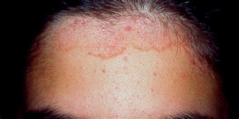 Dermatitis Seborreica Causas Síntomas Y Tratamiento Blog De