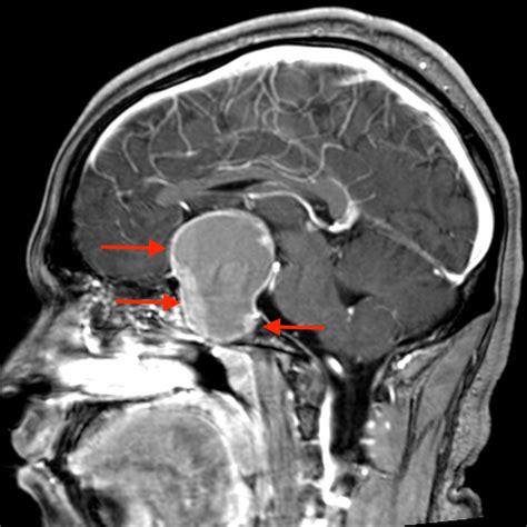 Prolactinoma Mimicking Migraine Consultant360