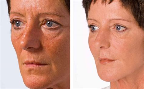 Pea Vie Non Surgical Facelifts Before And After