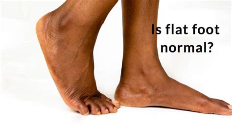 Time To Challenge The Flat Foot Consulting Footpain