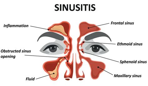 Sinusitis Sinus Infection Symptoms And Causes Parkway East Hospital