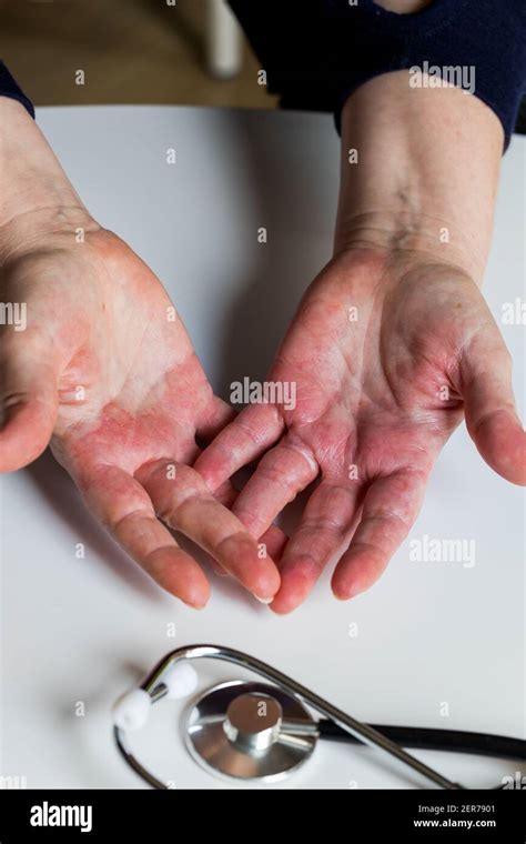Red Itchy Hands With Blisters Atopic Dermatitis A Visit To A