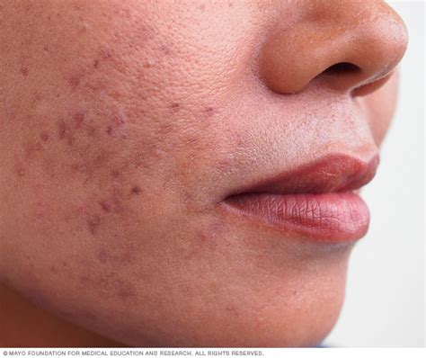 Acne Symptomscauses And Treatment For Health Tips