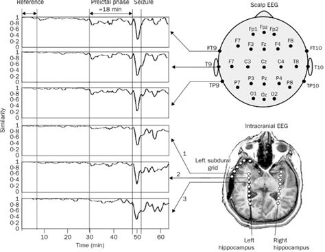 Prediction Of Epileptic Seizures The Lancet Neurology
