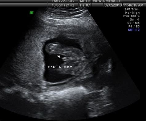 Its A Boy Ultrasound