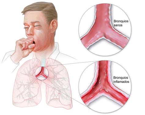 Acute Bronchitis In Adults Doctor At Home PV