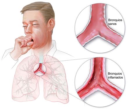 Maybe you would like to learn more about one of these? La bronquitis - Escuelapedia - Recursos ...