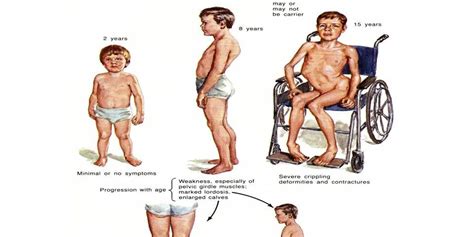 Muscular Dystrophy Symptoms And Treatment Charismatic Planet