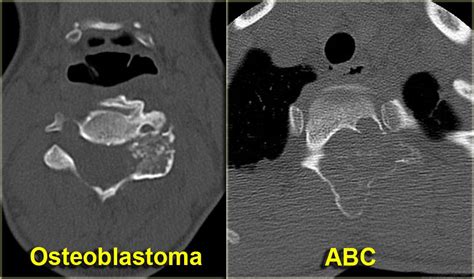 Radiologyspirit Osteoblastoma