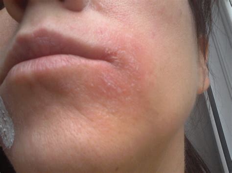 Eczema On Side Of Mouth Dorothee Padraig South West Skin Health Care